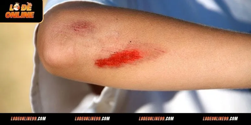 Mơ thấy trượt chân đánh con số gì khi bị chảy máu?